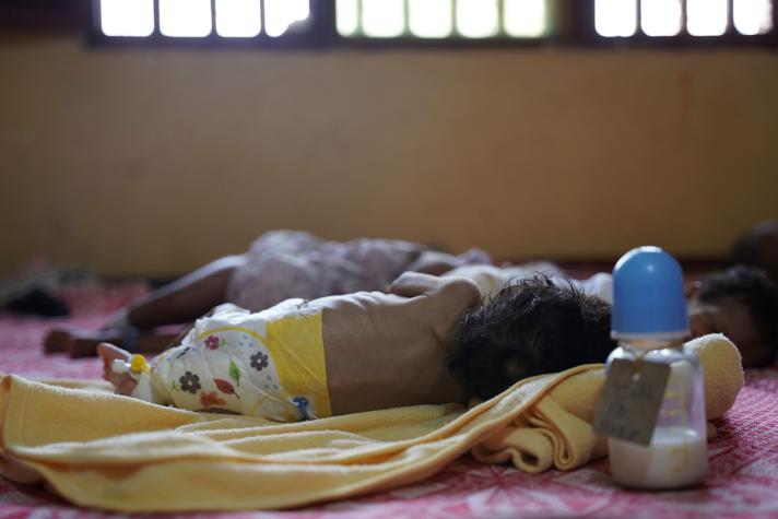 A severely malnourished child sleeps at Al-Dabbaghah Health Centre in Gezira state.
