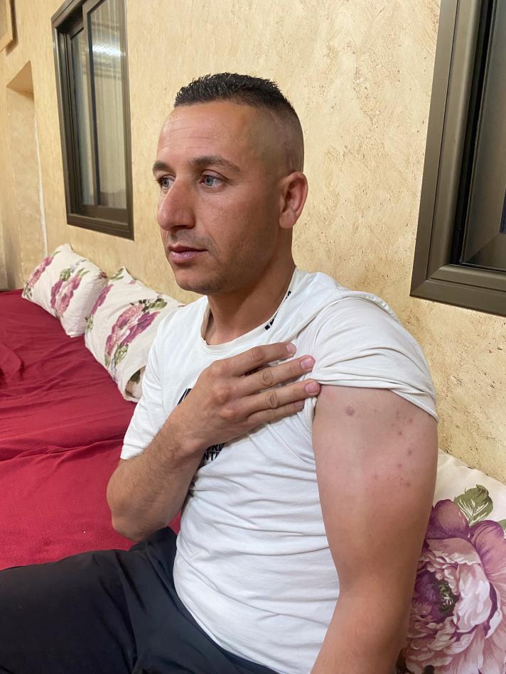 Eyad showing the scars of conflict on his upper arm.